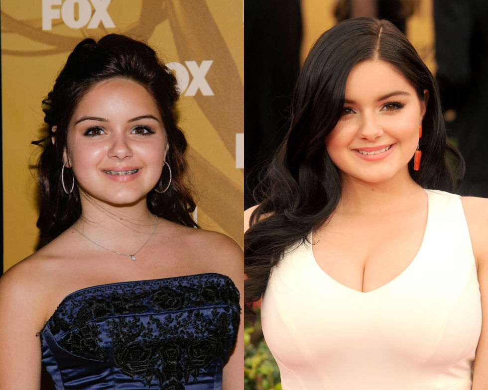 Orthodontics Australia  6 Celebrities With Braces Before and After —  Wonderful Transformations